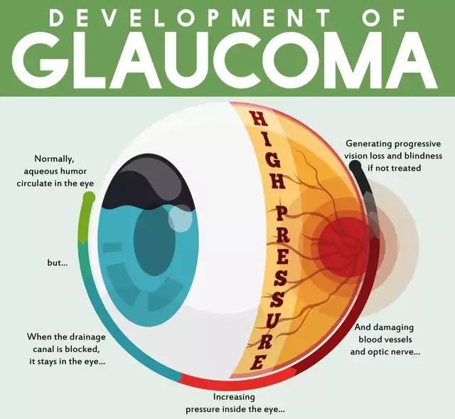 Infographic about the development of glaucoma and potential blindness