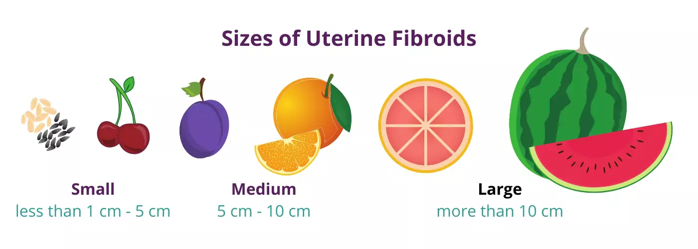 Sizes of uterine fibroids by USA Fibroids Centers