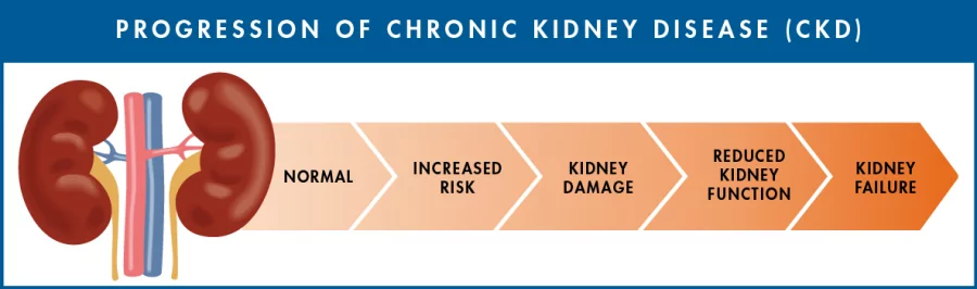 Infographic of progression of chronic kidney disease (CKD) by the CDC