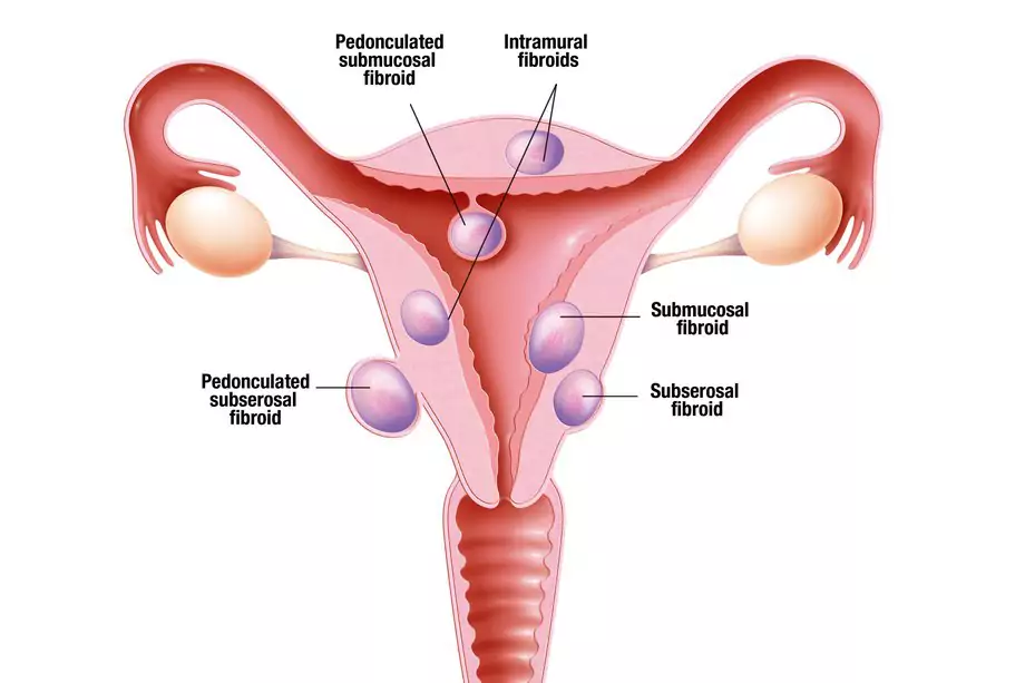 A diagram of the types of fibroids and where they are located in the uterus