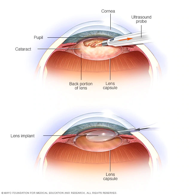 Infographic of cataract lens surgery