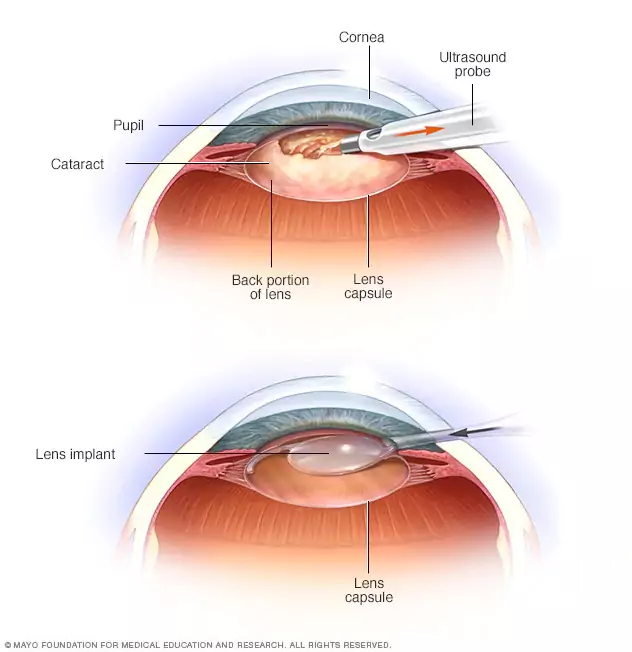 Infographic of cataract lens surgery
