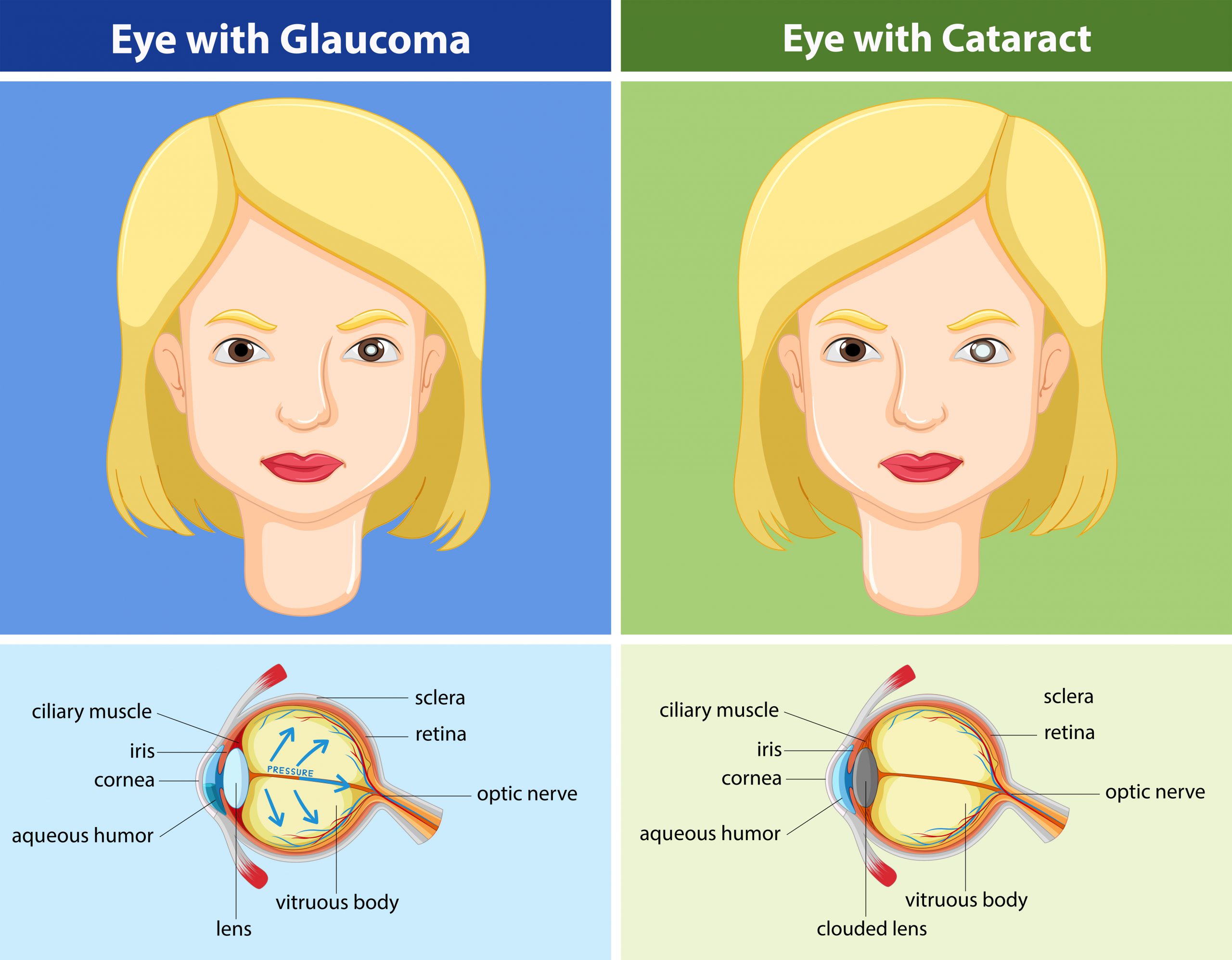 Glaucoma vs. Cataracts - The Glaucoma Community - Responsum Health