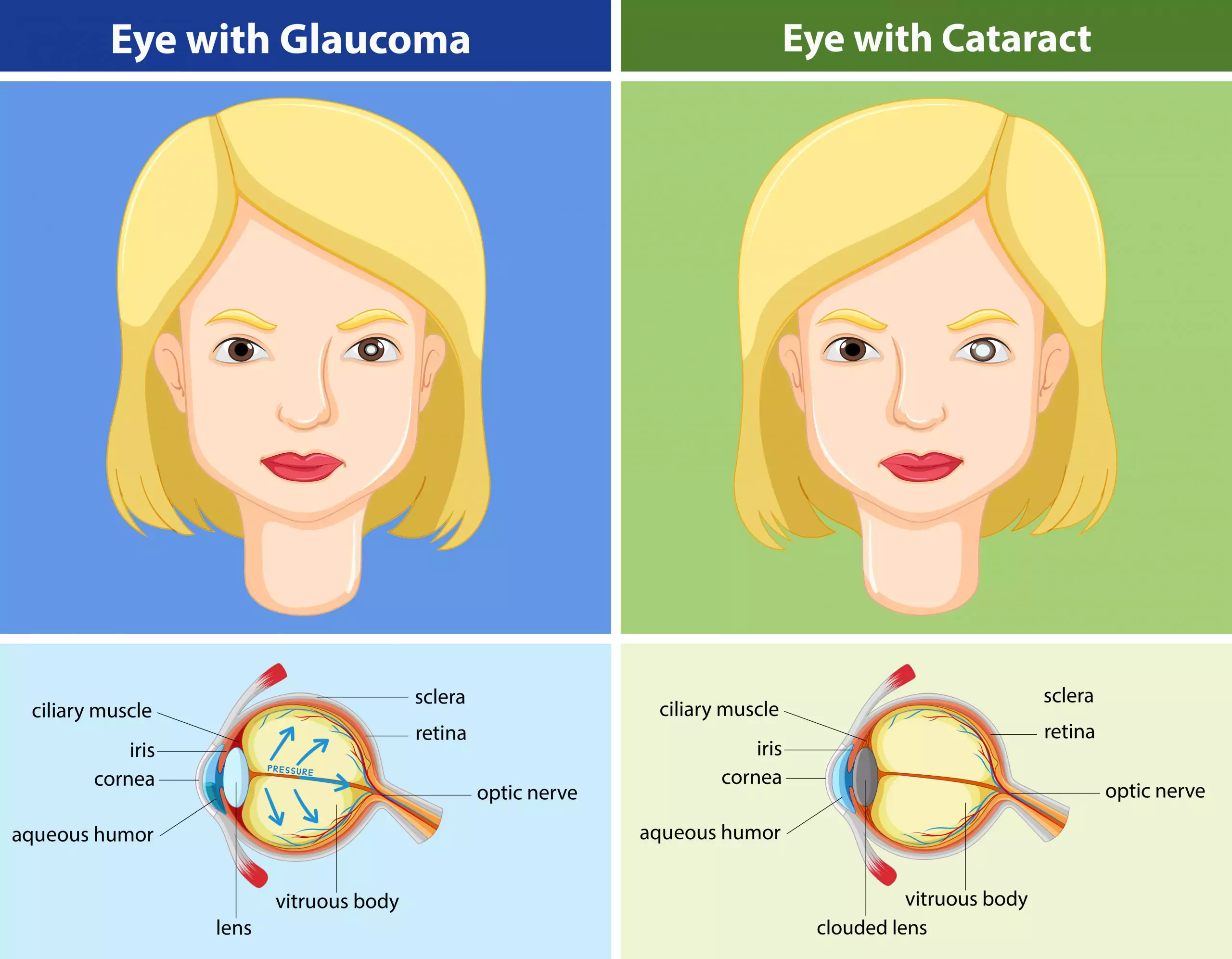 animation displaying the difference between glaucoma vs cataracts