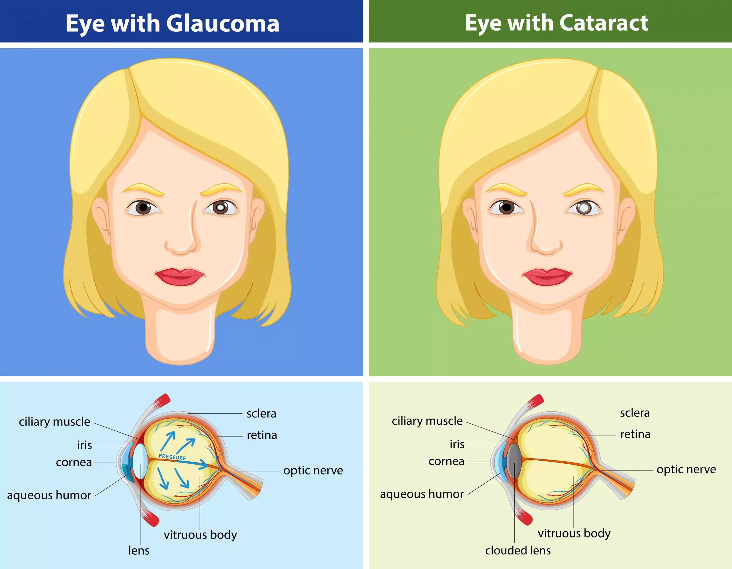 Glaucoma Vs Cataracts Whats The Difference Responsum Health 