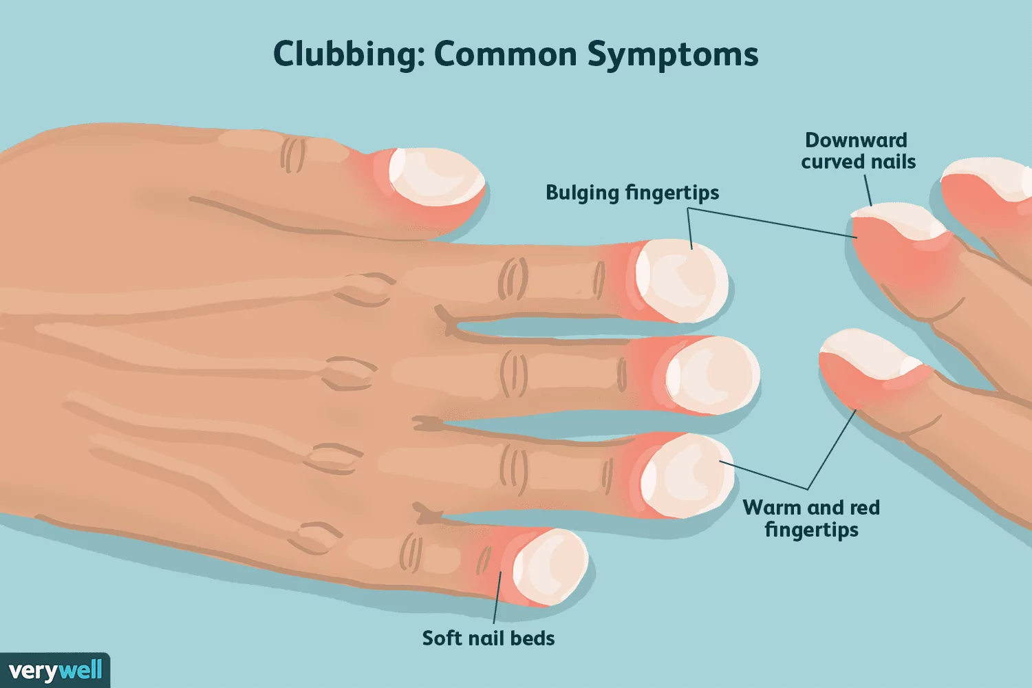 Clubbed finger symptoms related to pulmonary fibrosis