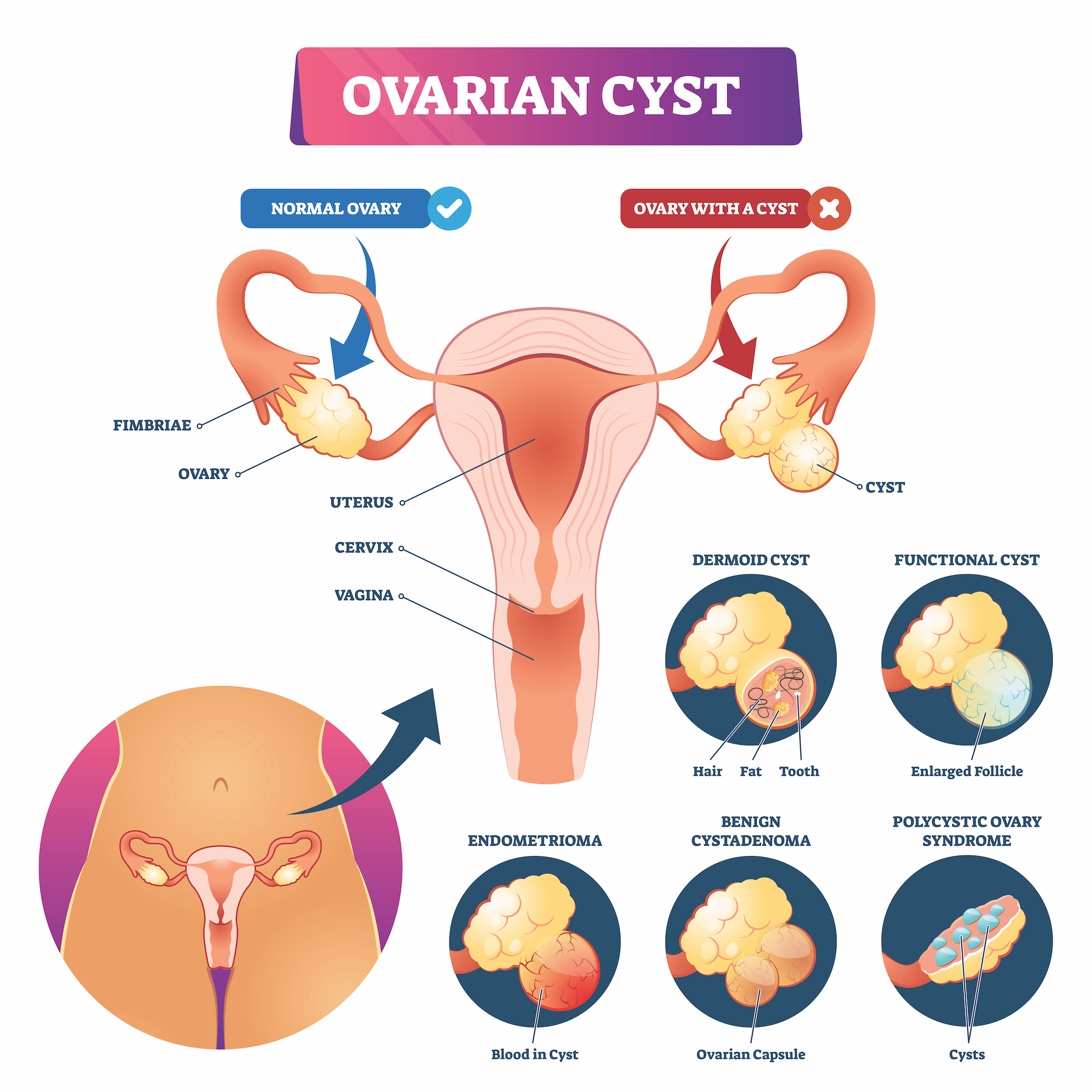 What Are The Cause Of Ovarian Cysts