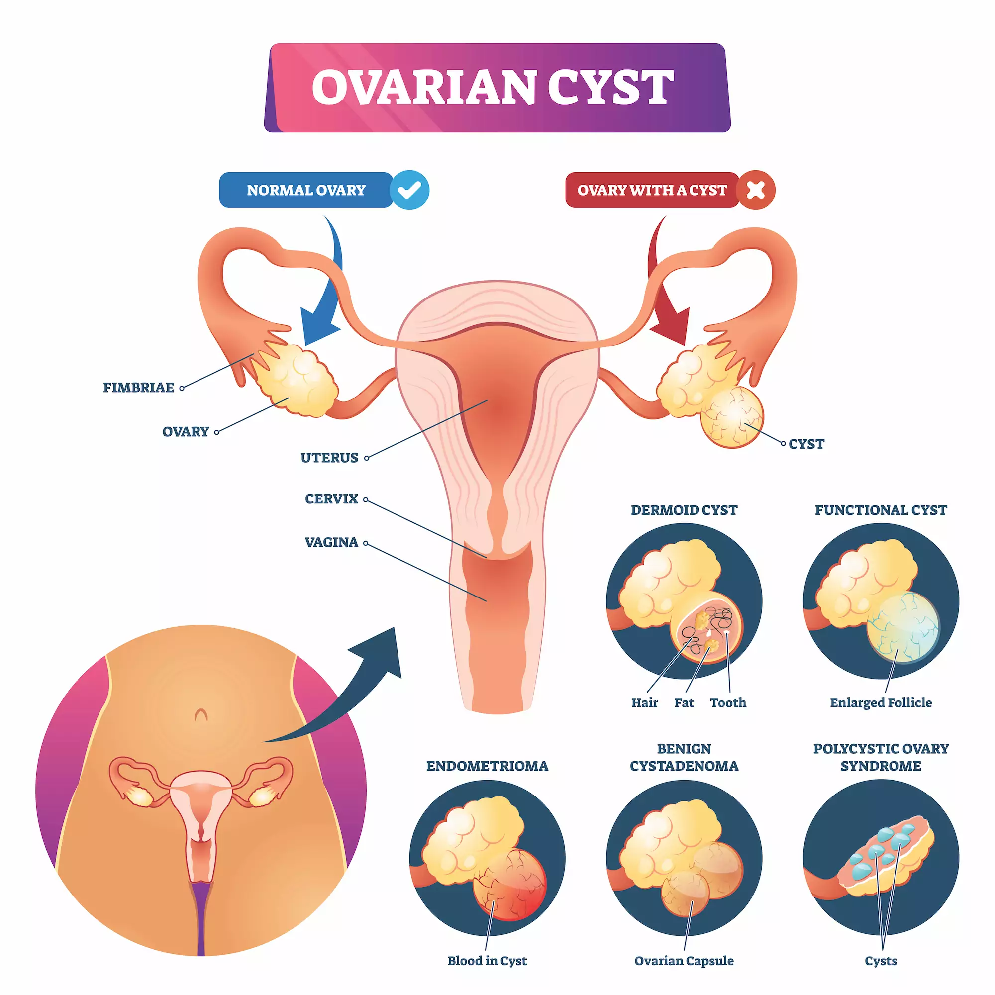 Ovarian cyst bleeding between periods sale