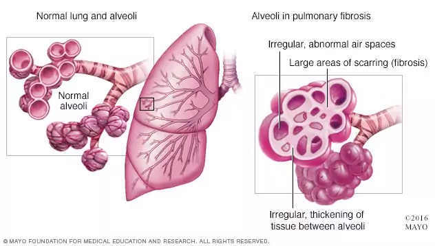 Healthy lung vs. lung with pulmonary fibrosis
