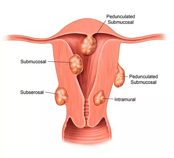 Diagram of different types of uterine fibroids