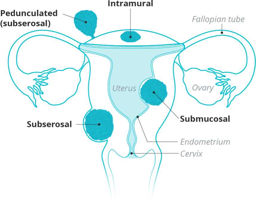Types of uterine fibroids, including subserosal fibroids