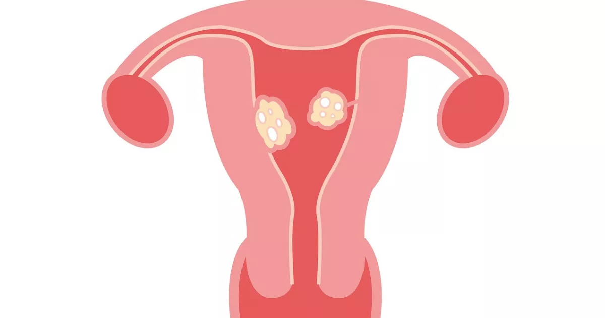 Size of fibroids