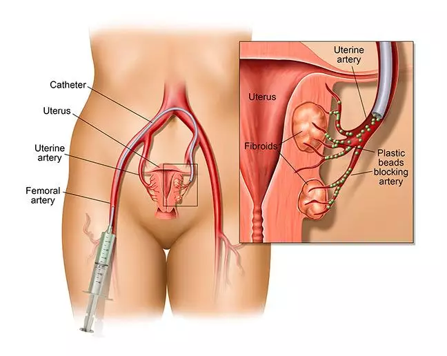 Illustration of Uterine Fibroid Embolization