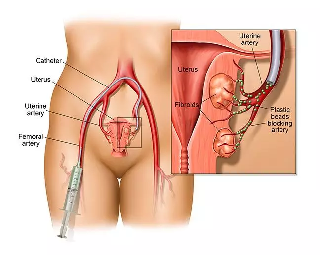 What Is Fibroid Expulsion? What You Need To Know