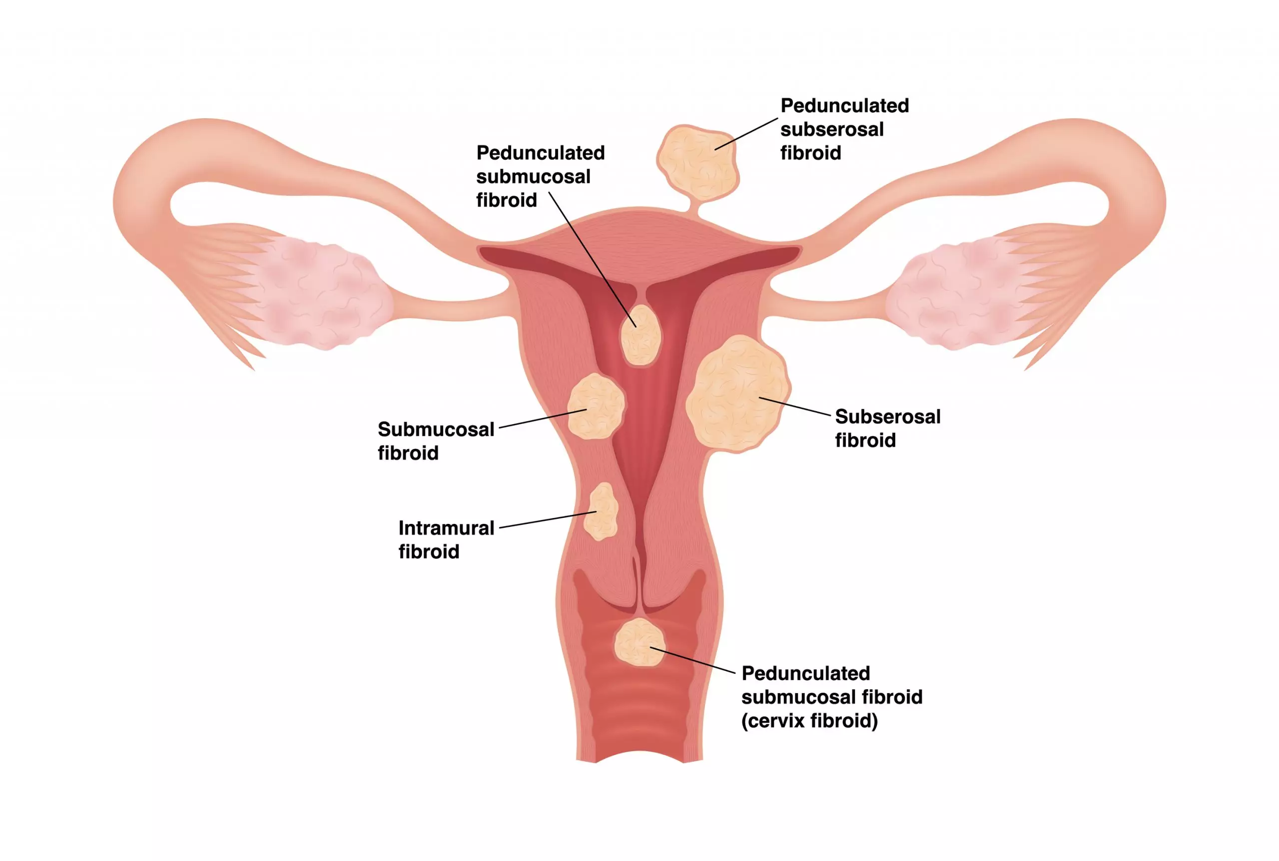 uterus fibroids