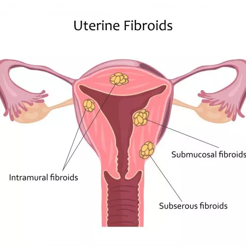 Uterine Fibroids Illustration