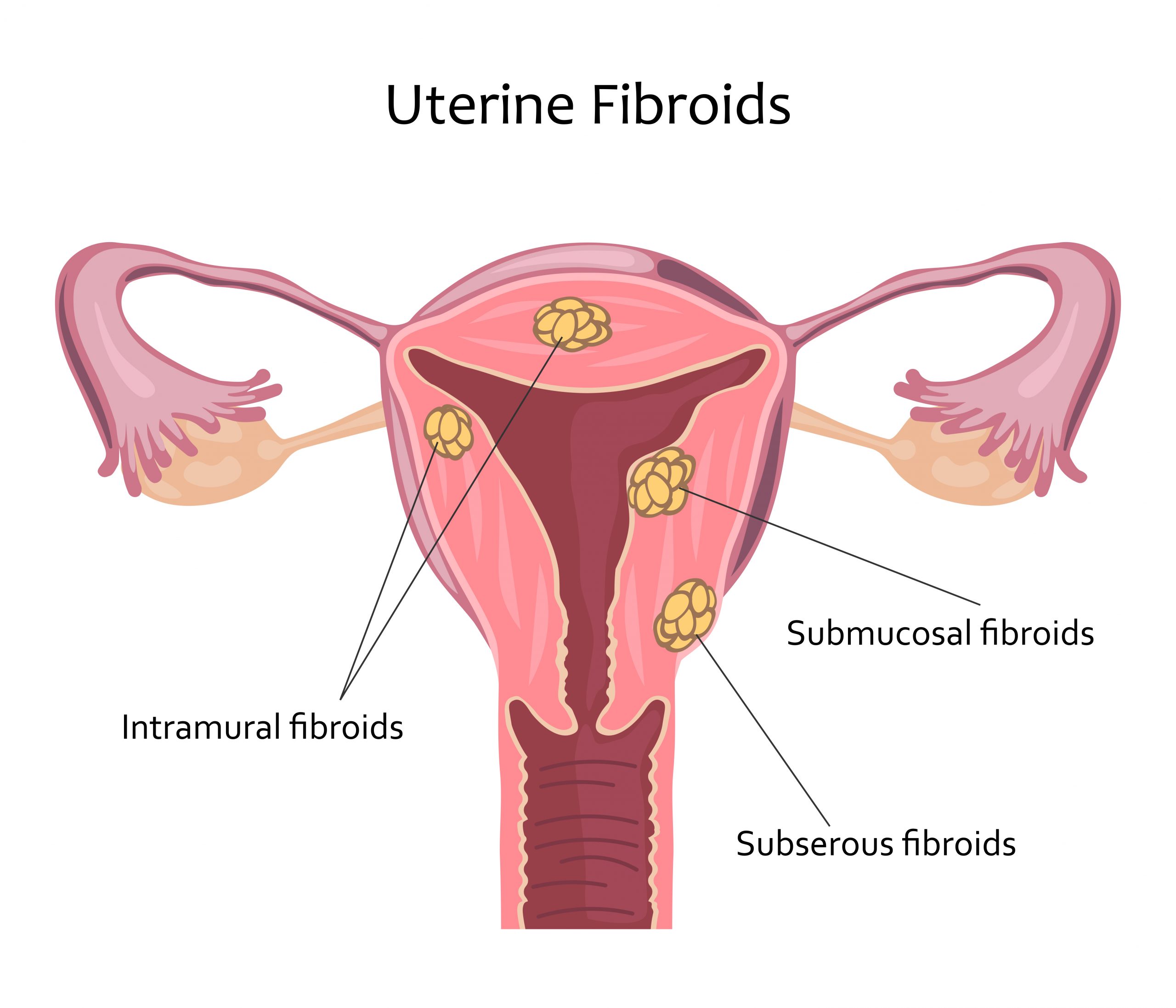 What Are Uterine Fibroids Responsum Health