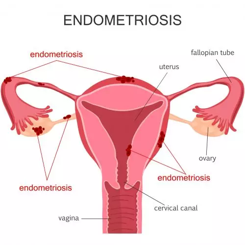 Endometriosis Diagram