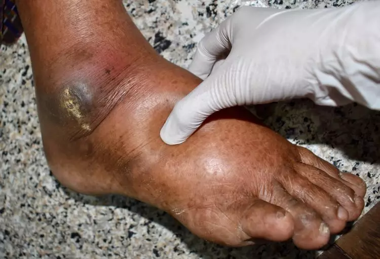 Doctor examining swollen foot with edema