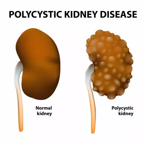 Illustration of comparison of normal kidney vs kidney with polycystic kidney disease
