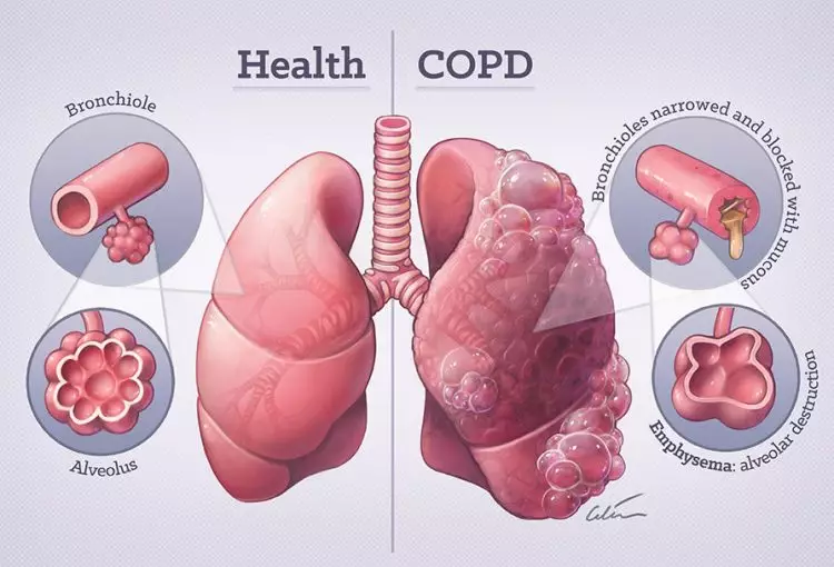 What Is COPD A Simple Guide To Understanding Your Lungs Responsum Health