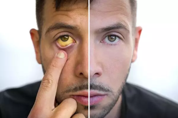 Man,Face,Divided,Into,Two,Parts,One,Healthy,And,One